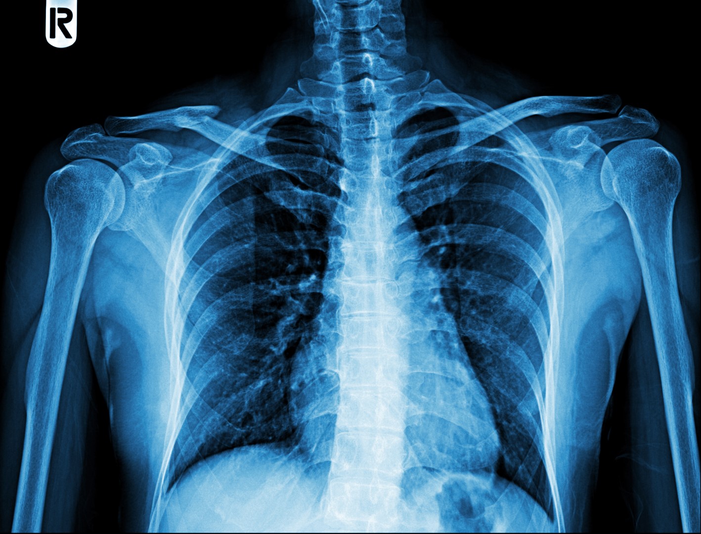 What is Tuberculosis?